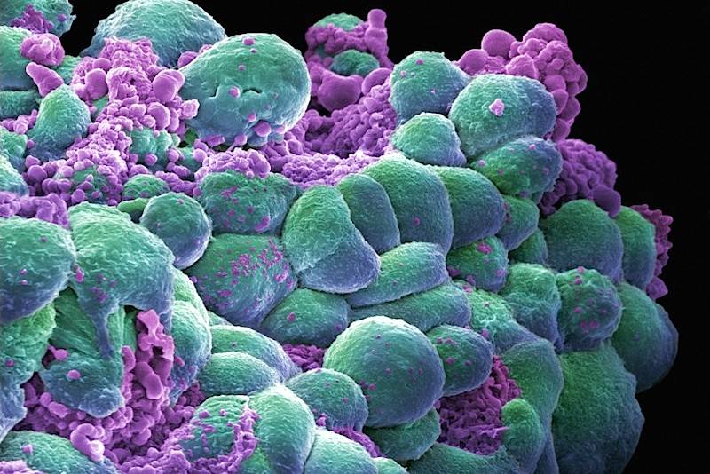 Um cluster de células cancerígenas num cancro de mama