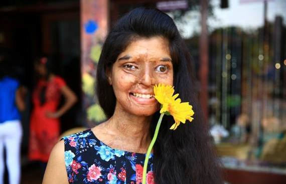 Ritu Saini foi atacada com ácido por não querer casar com o primo e acabou perdendo um olho