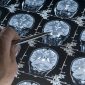 Vírus ataca câncer cerebral e estimula o sistema imunológico a atuar